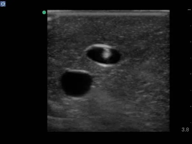 Internal Jugular Central Line Ultrasound Manikin