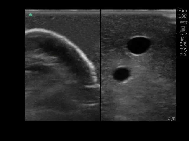 Internal Jugular Central Line Ultrasound Manikin
