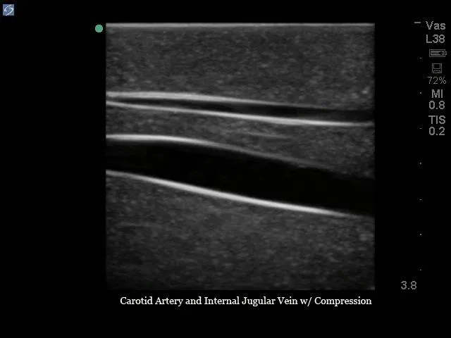Internal Jugular Central Line Ultrasound Manikin