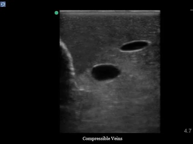 Internal Jugular Central Line Ultrasound Manikin